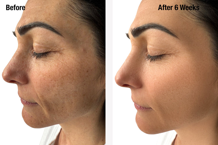 Before and after comparison of a woman's face with visible skin improvement over 6 weeks.