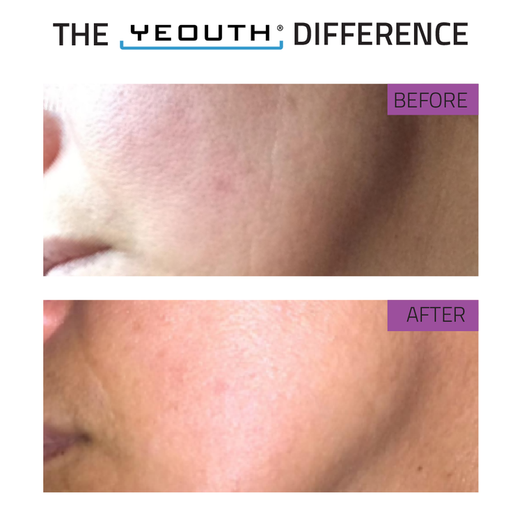 Before and after comparison of skin texture with 'The Yeouth Difference' branding.