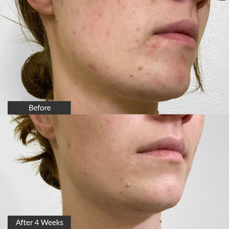 Before and after comparison of a person's neck with visible acne, labeled 'Before' and 'After 4 Weeks'.