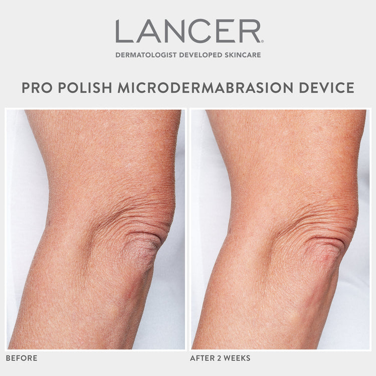 Pro Polish Microdermabrasion Device