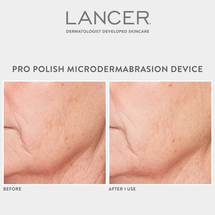 Pro Polish Microdermabrasion Device