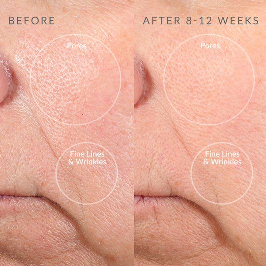 1001-BlushPro?Personal Microderm Pro Blush