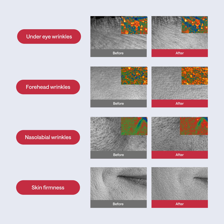 Before and after comparison of skin treatments on different areas including under eye, forehead, nasolabial, and skin firmness.
