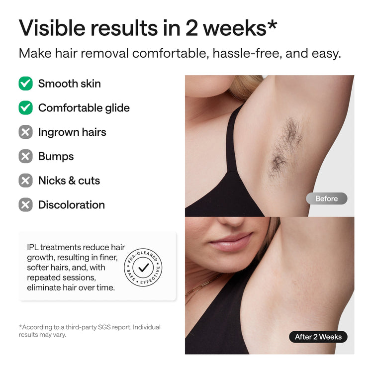 Advertisement for hair removal treatment showing before and after results with text about visible results in 2 weeks.