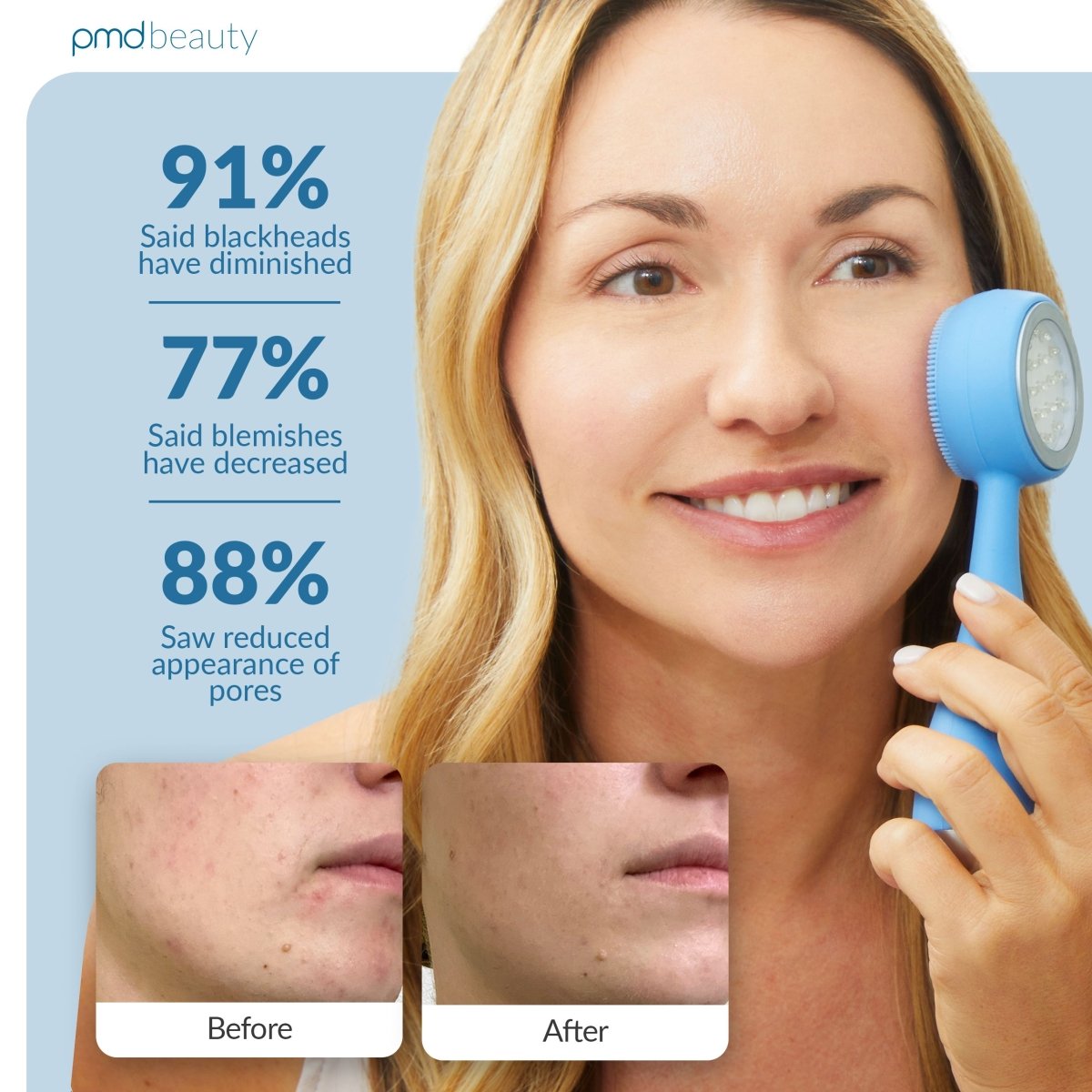 Woman using a skincare device with before and after results on a blue background, featuring PMD Beauty branding.