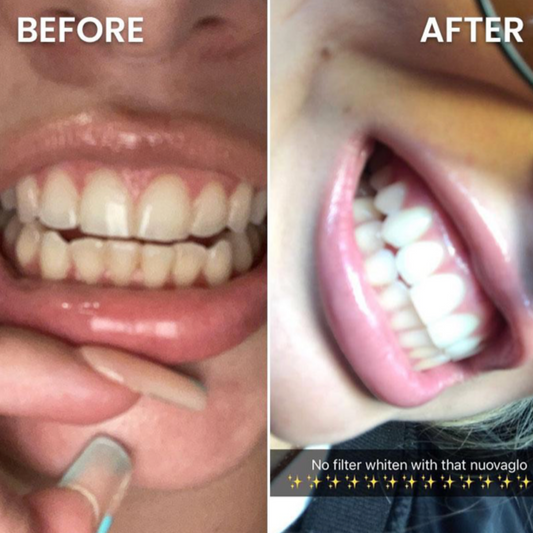 Woman using a teeth whitening device with Nuovaglo packaging and smartphone displaying results.