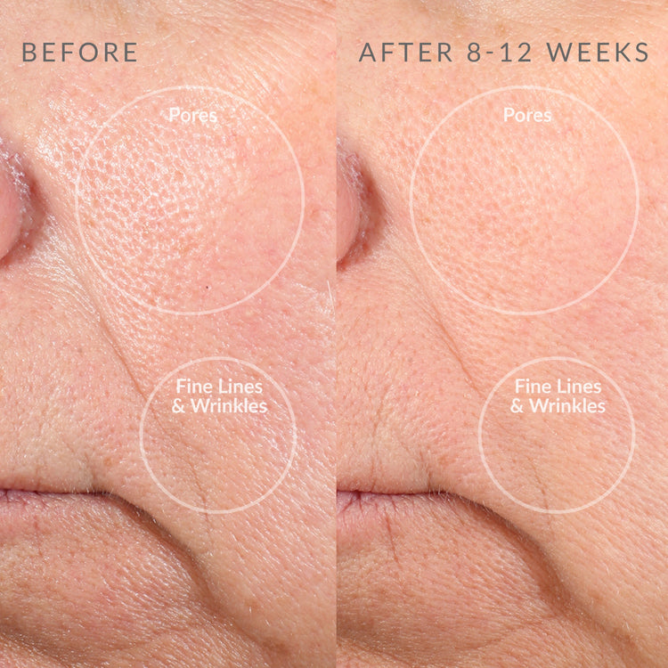 Before and after comparison of skin with pores and fine lines on a close-up of skin.