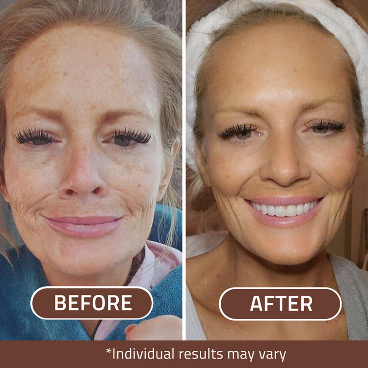 Before and after comparison of a woman's face with visible skin improvement.