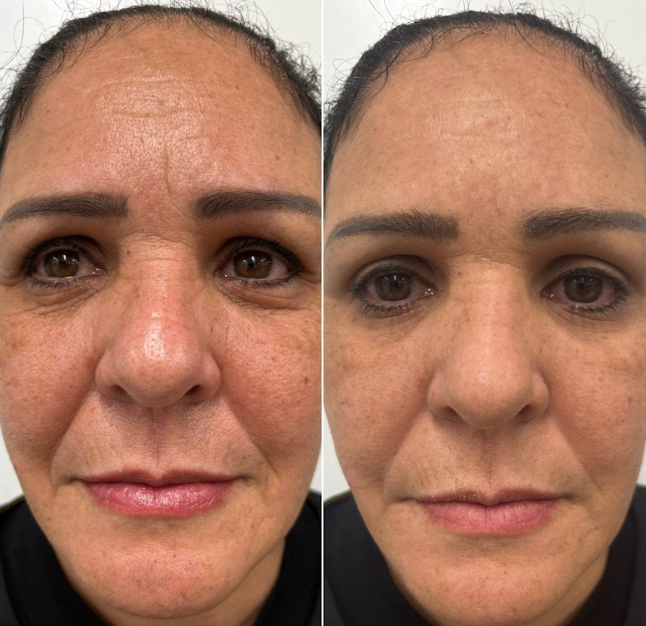 Before and after comparison of a woman's face with visible skin texture differences.