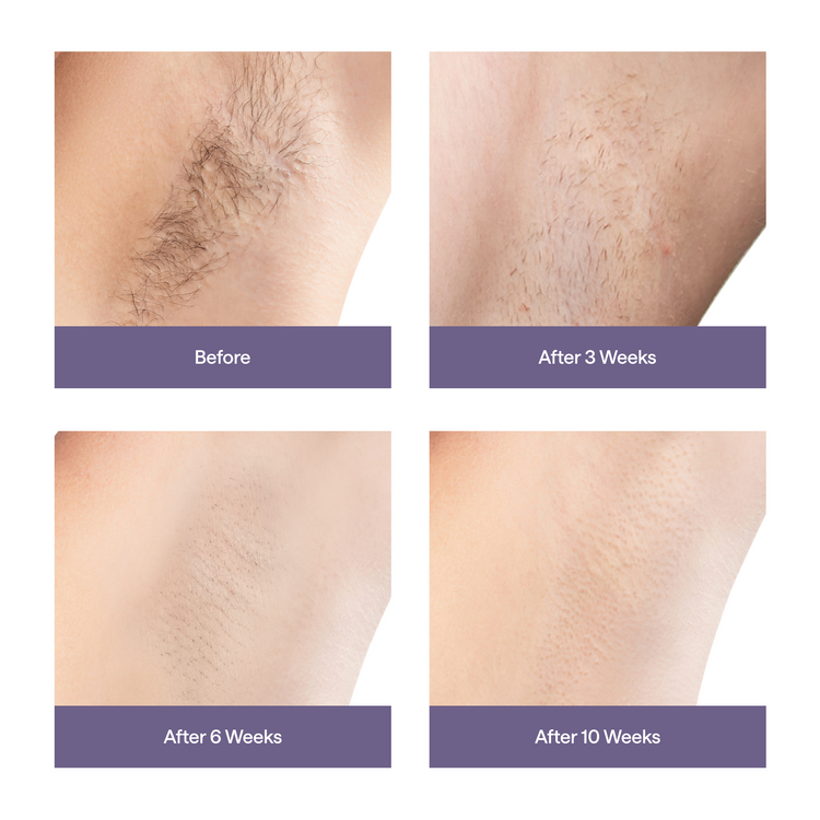 Ulike Air 3 - IPL Hair Removal Device - Purple