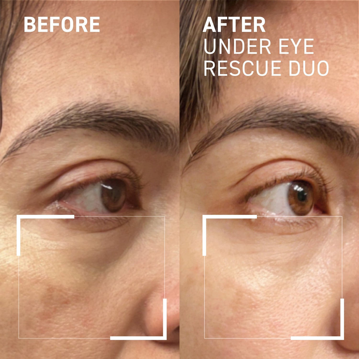 Before and after comparison of under-eye treatment showing reduced dark circles.