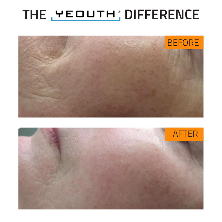 Before and after comparison of skin texture with 'The Yeouth Difference' branding.