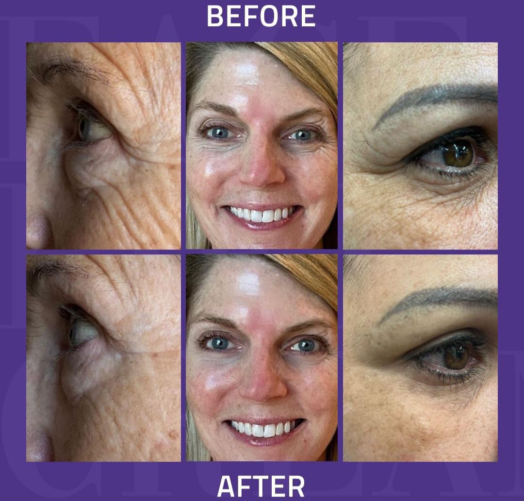 Before and after comparison of facial skin treatment with close-up views on a purple background.