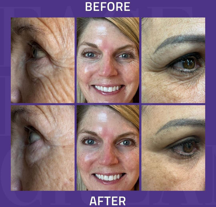 Before and after comparison of facial skin treatment with close-up views on a purple background.