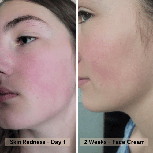 before and after using the hydration recovery face cream for red irritated skin