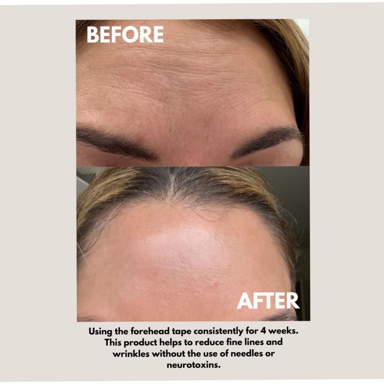 Seald™ Forehead Tape – Wrinkle Smoothing Patches