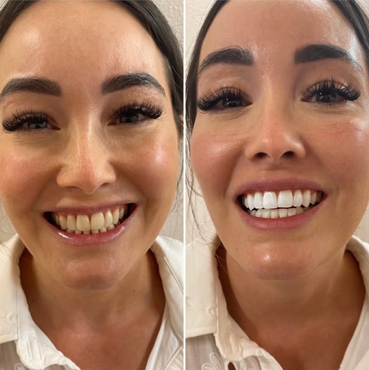 Woman using a teeth whitening device with Nuovaglo packaging and smartphone displaying results.