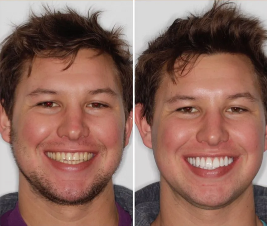 Woman using a teeth whitening device with Nuovaglo packaging and smartphone displaying results.